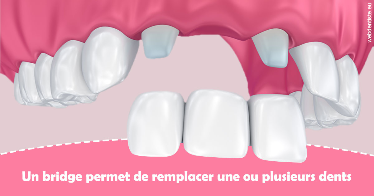 https://dr-ari-djebali.chirurgiens-dentistes.fr/Bridge remplacer dents 2