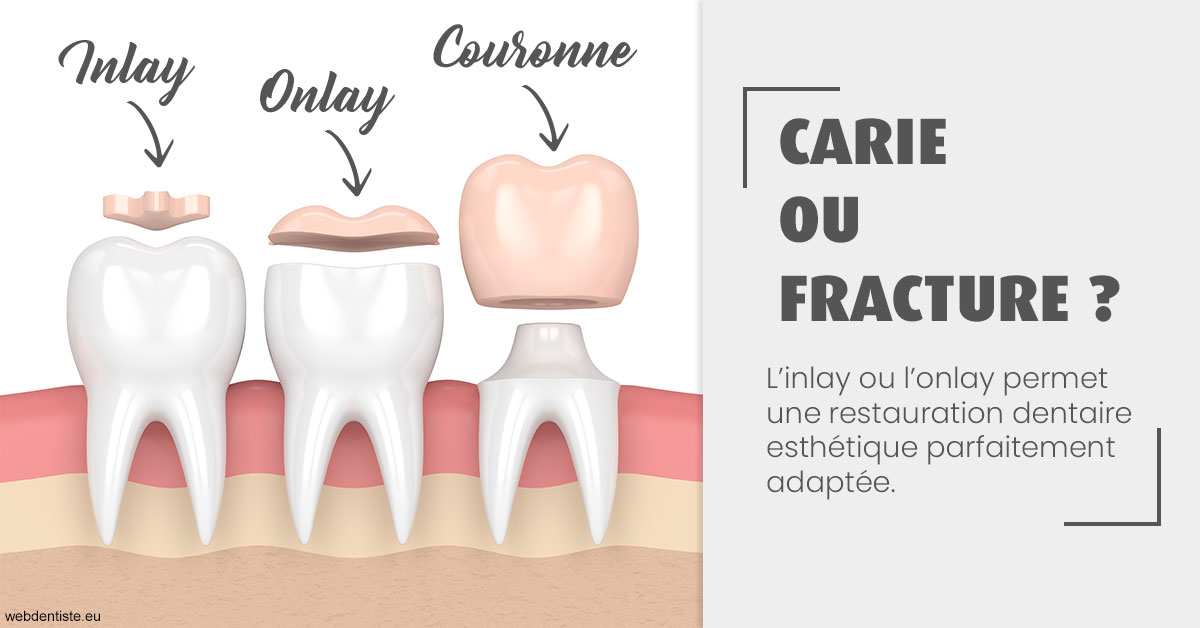 https://dr-ari-djebali.chirurgiens-dentistes.fr/T2 2023 - Carie ou fracture 1