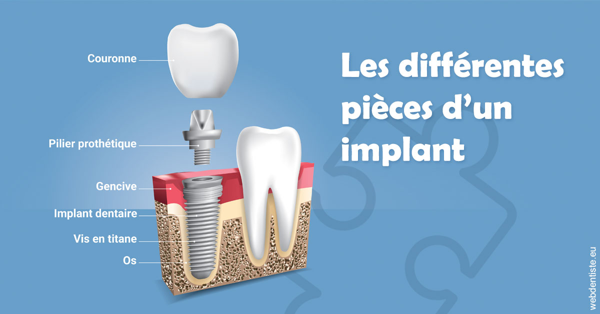 https://dr-ari-djebali.chirurgiens-dentistes.fr/Les différentes pièces d’un implant 1